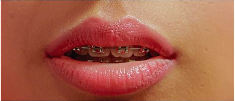 Dry lips with braces